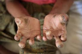 World Leprosy Day: Challenge misconceptions, spread awareness and promote inclusion - GHS charges public